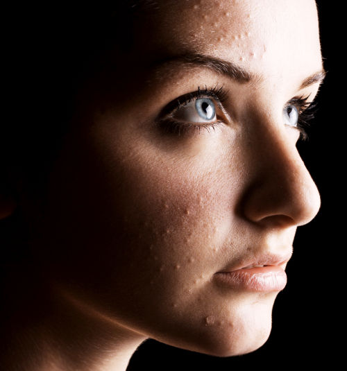 Nichtentzündliche Akne im Gesicht einer Frau